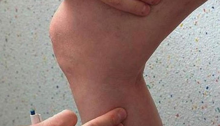 Важно е тромбозата да се хване в най-ранния възможен етап, за да се предотвратят усложненията Важно е тромбозата да се хване в най-ранния възможен етап, за да се предотвратят усложненията