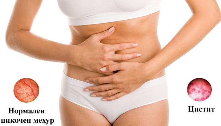 Ако циститът е станал хроничен, трябва да си направите задълбочени изследвания, включително цистоскопия Ако циститът е станал хроничен, трябва да си направите задълбочени изследвания, включително цистоскопия