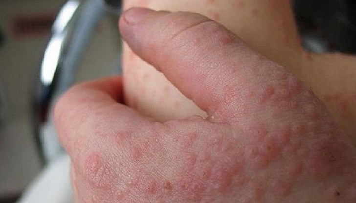 Кое е причината за връщането на смъртоносния патоген, който вреди на човешкия организъм, като най-сериозно от него страдат децата Кое е причината за връщането на смъртоносния патоген, който вреди на човешкия организъм, като най-сериозно от него страдат децата