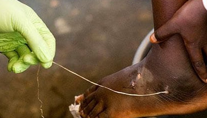 Дракункулозата е на път да стане втората болест след едрата шарка, която човечеството ще успее да изкорени, смятат учени Дракункулозата е на път да стане втората болест след едрата шарка, която човечеството ще успее да изкорени, смятат учени