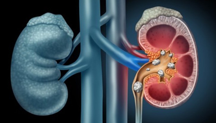 Ако бъбреците са подложени на прекалено много стрес, те могат да си вършат работата лошо Ако бъбреците са подложени на прекалено много стрес, те могат да си вършат работата лошо