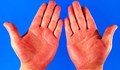 Червените длани са признак на тежко заболяване