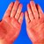 Червените длани са признак на тежко заболяване