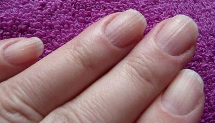 Вертикални или хоризонтални бразди по ноктите подсказват за здравословни проблеми