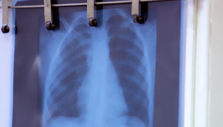 Пневмонията е възпаление на белите дробове, което може да доведе до сериозни усложнения и смърт при липса на лечение