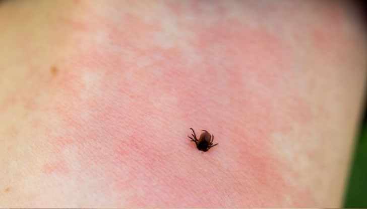 65-годишната жена е получила Кримско-конгоанска хеморагична треска 65-годишната жена е получила Кримско-конгоанска хеморагична треска