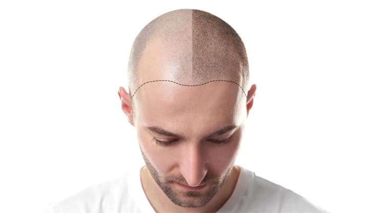 Татуирането на коса може да спести много психични проблеми на мъже, които свързват оплешивяването със загуба на своята мъжественост