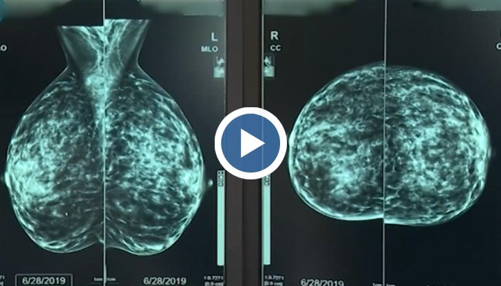 "Ракът на млечната жлеза остава на първо място като причина за смъртност при жени след 30 г