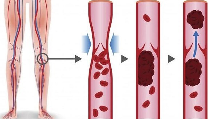 Не всеки кръвен съсирек води до смърт