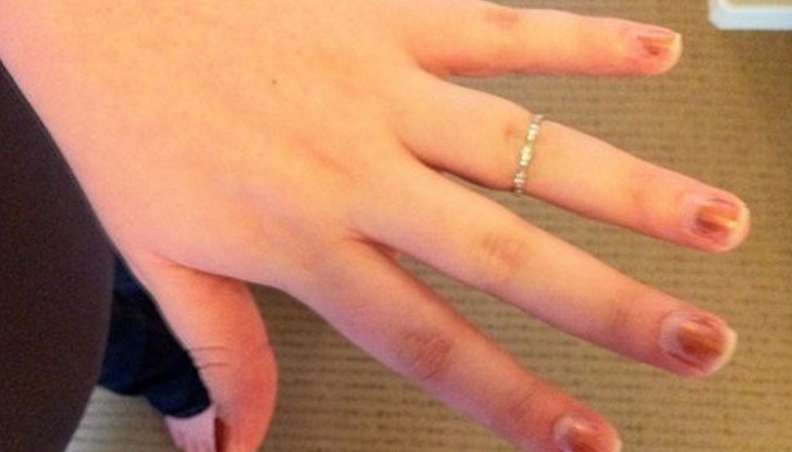 Пръстите на ръцете могат да се подуят толкова много, че да не може да свалите пръстените си