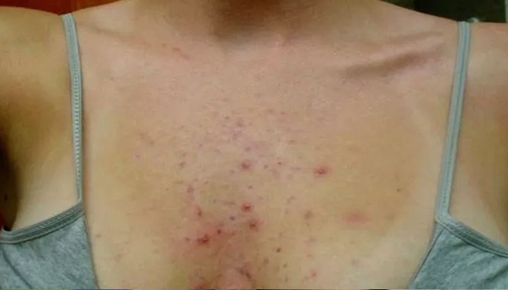 Възможни причини за поява на пъпки в тази област Възможни причини за поява на пъпки в тази област