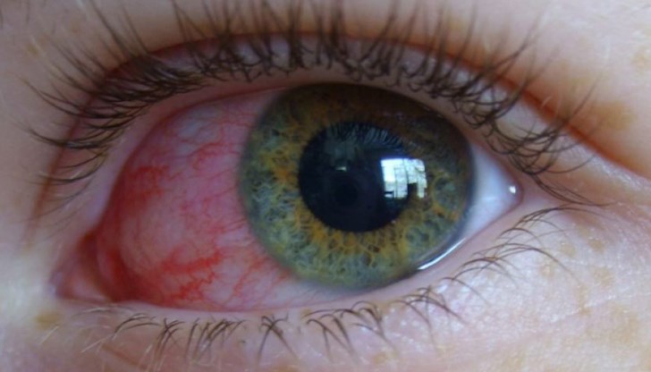 Коронавирусът може да влезе в клетките на тялото, като по този начин активира процеса на възпаление, придружен от симптоми на конюнктивит.