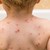 Грипът в Русе е под средната заболеваемост, но има ръст на заразени с варицела