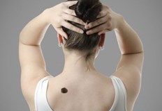 Под обичайните бенки обикновено се маскира един от най опасните и