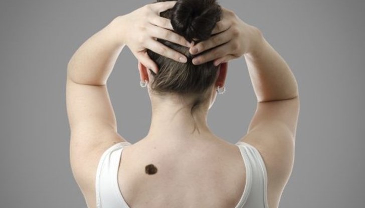 Преди меланомът да метастазира, той е напълно лечим Преди меланомът да метастазира, той е напълно лечим