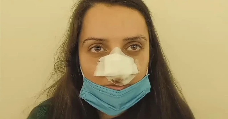 При инцидента носът на момичето е отхапанМладо момиче се нуждае