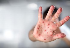 Световната здравна организация СЗО разполага 92 потвърдени случая на маймунска