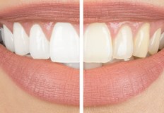 Докато знаменитостите и моделите могат да се радват на ярки бели