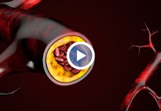 Какви са тайните на холестерола Кога добрият холестерол се превръща