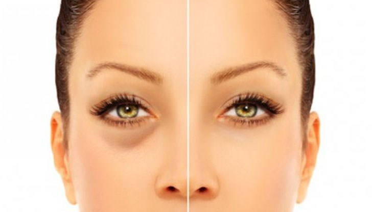 По-трудно е човек да се избави от бъбречните отоци, тъй като бъбречната недостатъчност не се поддава лесно на лечение