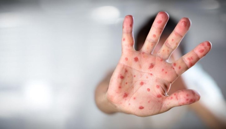 Маймунската шарка е рядко вирусно заболяване, което се предава главно на хората от диви животни (гризачи, примати) Маймунската шарка е рядко вирусно заболяване, което се предава главно на хората от диви животни (гризачи, примати)