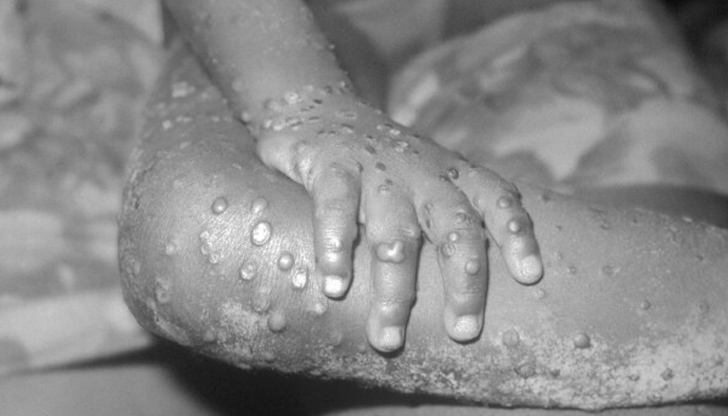 Броят на потвърдените случаи на маймунска шарка в световен мащаб