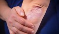 Д-р Жана Казанджиева обясни какви са правилните грижи за кожата при псориазис