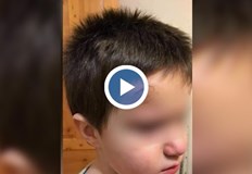 Синини и следи от забит молив в челото Родителисигнализираха че шестгодишните