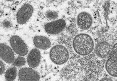 Нов случай на маймунска шарка беше потвърден в Румъния днесТова