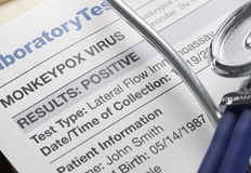 Това съобщава испанското здравно министерствоБроят на потвърдените случаи на маймунска