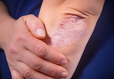 Съвременната медицина приема псориазиса за системно заболяване което засяга не