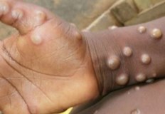 Световната здравна организация СЗО съобщи че засилващото се разпространение на