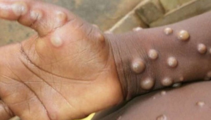 Въпреки това Световната здравна организация отбелязва „кризисния характер” на заразата