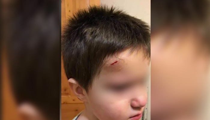 Синини и следи от забит молив в челото.Родителисигнализираха, че шестгодишните