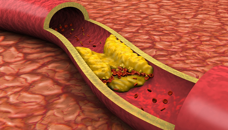 За да се предотврати натрупването на мастни депозити в клетките,