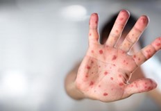 За първи път в САЩ бяха открити случаи на маймунска