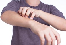 Сърбежът след ухапване от комари създава значителен дискомфортНякои достъпни средства