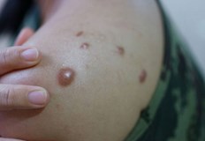 Испания и Бразилия регистрираха първите смъртни случаи извън АфрикаСветовната здравна