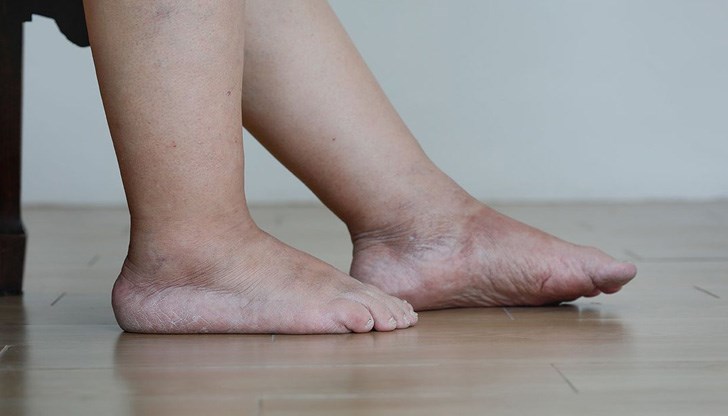 Задържането на течности е често срещано състояние Задържането на течности е често срещано състояние