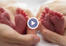 Случаят е от БразилияСиамски близнаци в Бразилия бяха успешно разделени