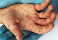 Новият вирус засяга малчугани на възраст между 2 и 5