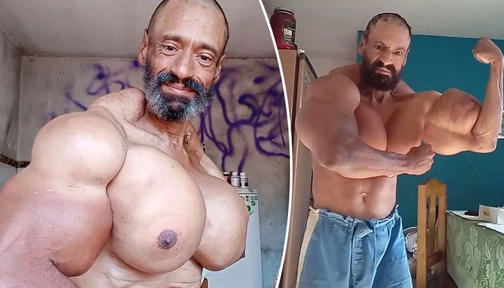 Валдир Сегато е бил предупреден от лекари, че може да получи инфаркт, вътрешни инфекции или ампутация на крайниците, но той не спрял с инжекциите