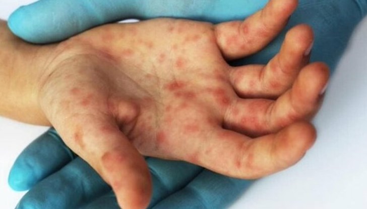 Новият вирус засяга малчугани на възраст между 2 и 5 години