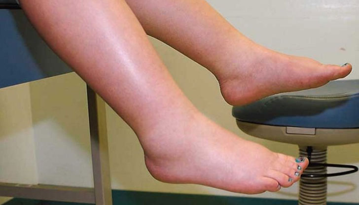 Задържането на вода може да е знак за сериозен проблемАко