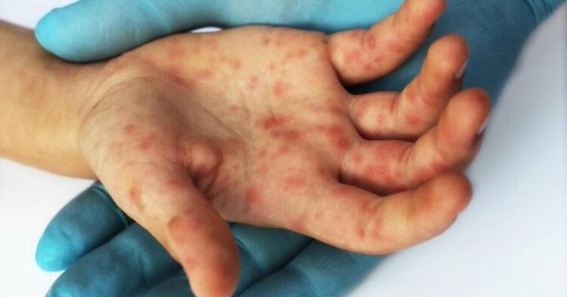 Новият вирус засяга малчугани на възраст между 2 и 5