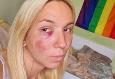 Емили с тротинетката която катастрофира лошо преди седмица вече се