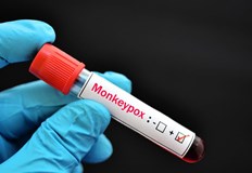 Потвърдиха шести случай на маймунска шарка у насТова съобщиха от