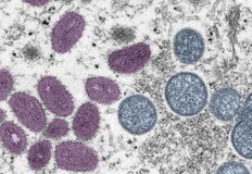 Маймунската шарка понякога може да доведе до неврологични или психиатрични