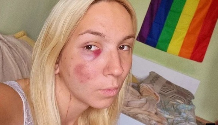 Емили с тротинетката, която катастрофира лошо преди седмица, вече се е оправила Емили с тротинетката, която катастрофира лошо преди седмица, вече се е оправила