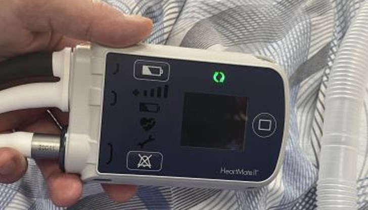 Устройството дава възможност на пациентите да бъдат стабилизирани, изписани и да дочакат сърдечна трансплантация